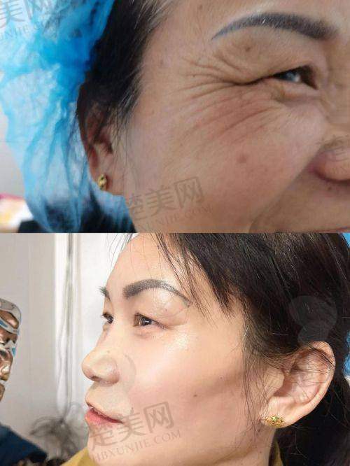一、微拉美与无痕筋膜悬吊提升术原理大不同