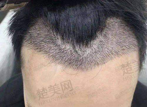 七、深圳陈群筋膜提升与其他抗衰项目对比