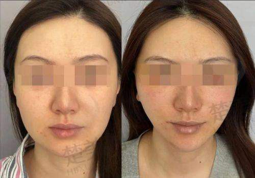 三、成都李建钢无痕筋膜提升痛不痛？真实体验分享