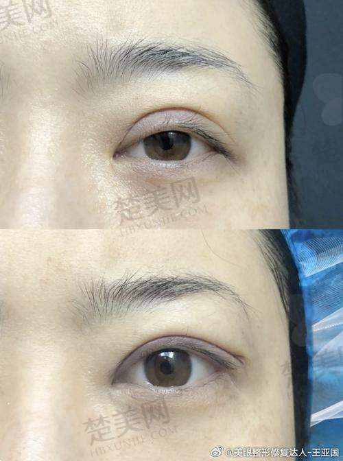 七、谢福庚医生——深圳富华医疗美容医院的多样化风格眼修复骨干医生
