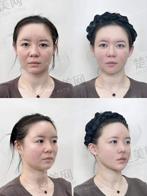 五、牙齿美白——展露靓丽笑容