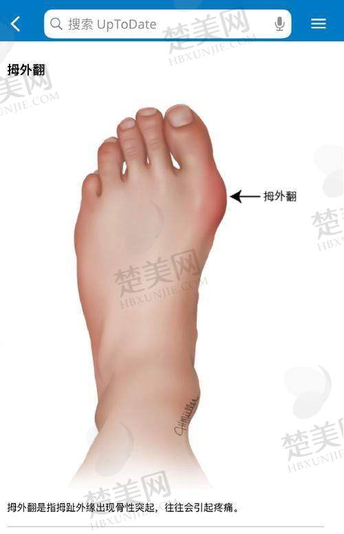 北京大脚骨整形医院选择避坑指南
