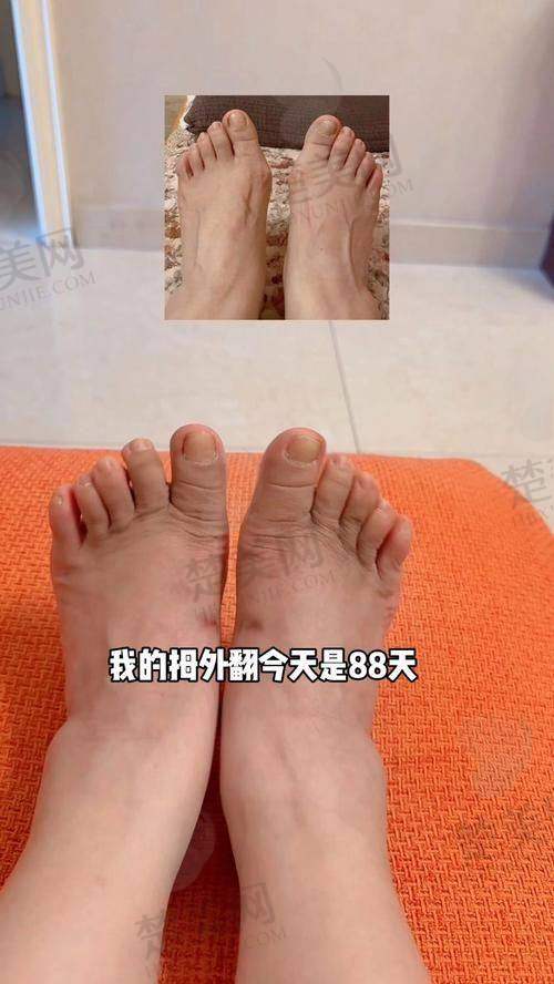 二、北京马文足科——国内大脚骨矫正专科典范