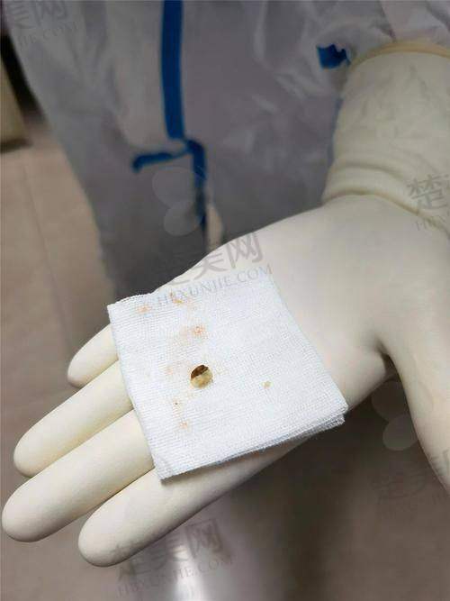 三、广州市荔湾中 心医院异物取出项目优势