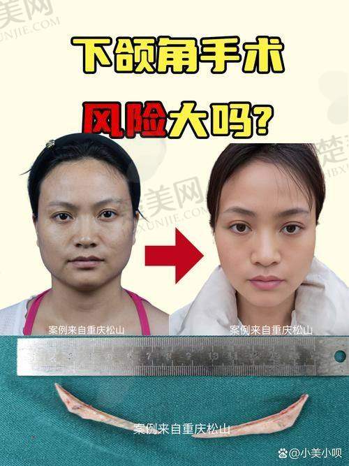 三、李志海磨骨的技术优势与特色
