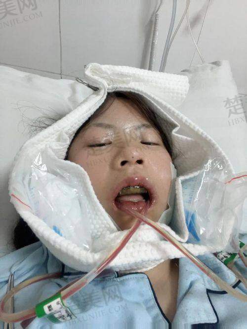 五、为什么要选择李运峰医生做正颌手术