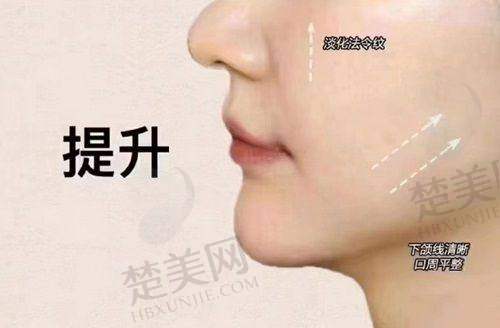 三、李晓东pst面部提升成效呈现
