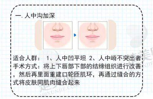 二、王晓健人中缩短术的技术特点