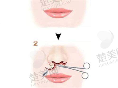 六、王晓健人中缩短术的患者评价