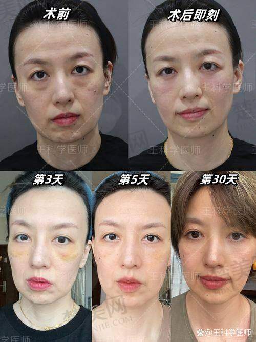 二、佛山顺德壹加壹整形医院：隐痕祛眼袋热门款，经验医生把控细节