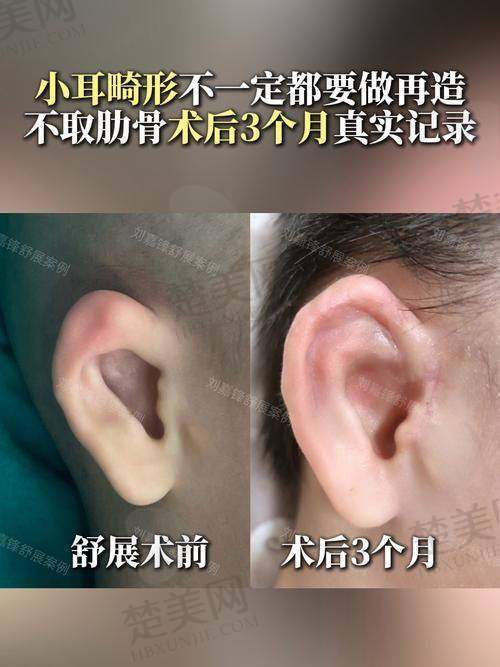 七、耳再造手术价格参考