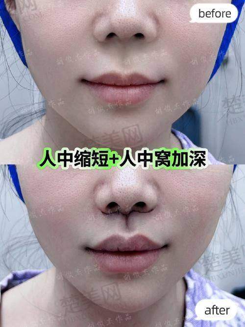三、王晓健人中缩短术的成效体现