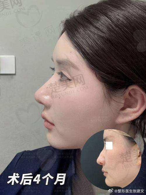 五、嘉兴艺星汪泽群院长隆鼻的实际实例和患者评价