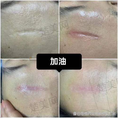 重庆万州区疤痕修复费用一览表