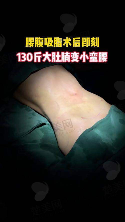 二、杨宇梓医生做腰腹环吸的技术优势