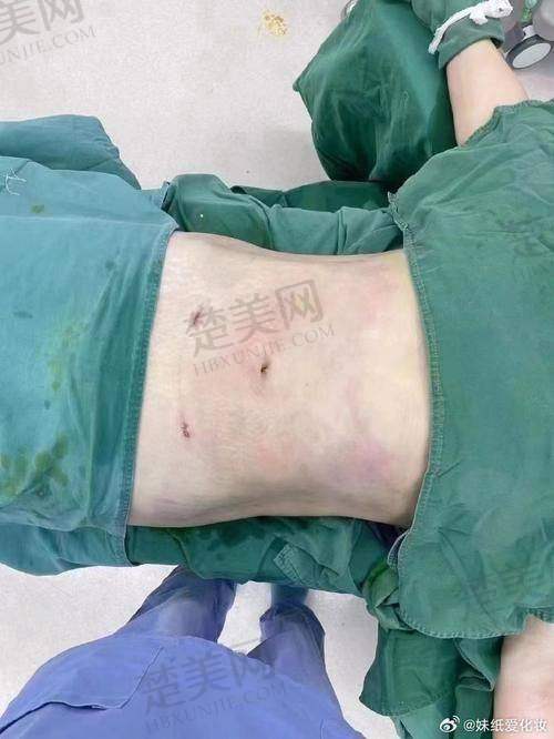 五、腰腹环吸手术的全过程体验