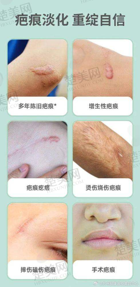 三、与同行对比苏州乐桥疤痕研究院收费情况