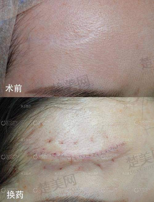 二、影响苏州乐桥疤痕研究院收费的关键因素