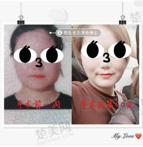 三、广州磨骨术前功课