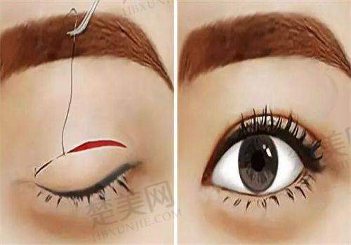 2025年揭秘北京大学深圳医院双眼皮实力:价格明细、真实案例与美眼攻略分享