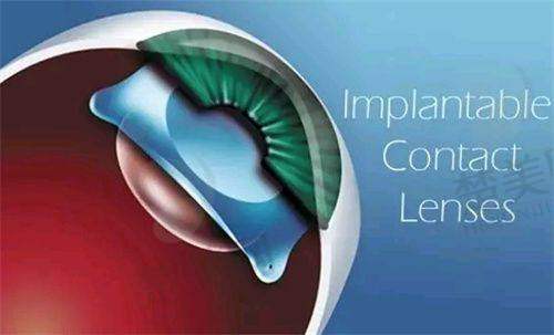 2025重庆蔡司smile3.0全飞秒手术费用大公开,各医院价格及地址等信息全知道
