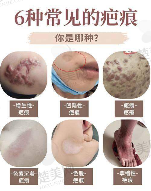 深圳悦尔疤痕胎记专科值得信赖吗?专业团队技术优服务佳助祛疤!